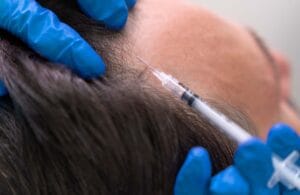 Read more about the article How PRP Hair Treatment Works and Why It&rsquo;s a Game-Changer for Hair Loss