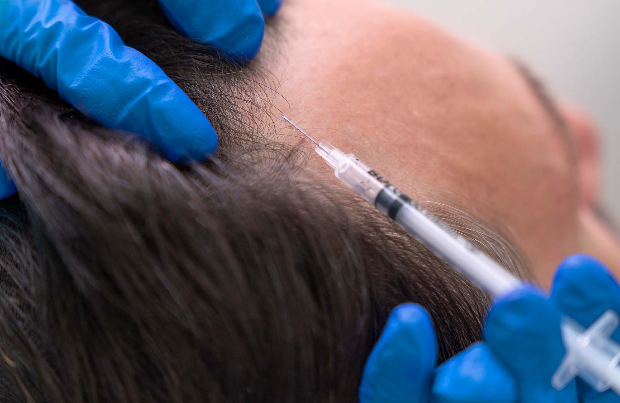 Read more about the article How PRP Hair Treatment Works and Why It&rsquo;s a Game-Changer for Hair Loss