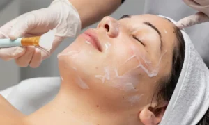Read more about the article VI Peel: A Simple Solution for Hyperpigmentation and Acne Scars