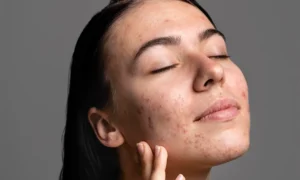 Read more about the article Microneedling for Acne Scars: What to Expect and How It Works