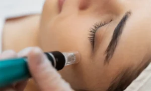 Read more about the article Microneedling Under Eyes: A New Solution for Dark Circles and Fine Lines