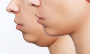 Read more about the article Kybella Treatment for Double Chin: How It Works and What to Know