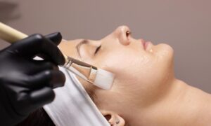 Read more about the article Chemical Peels for Clearer, Smoother Skin