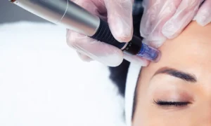 Read more about the article Skin Pen Microneedling in Woodbury, NY for Smoother, Clearer Skin
