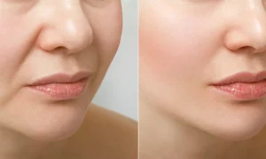Read more about the article MicroFat Injections in Woodbury: Restore, Repair & Relieve Naturally