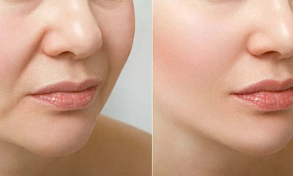 Microfat injections